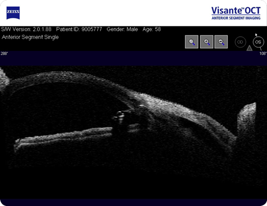 Fig. 2-Shunt ExPress, observa-se o lago intra-escleral e a bolha de filtração sub-conjuntival