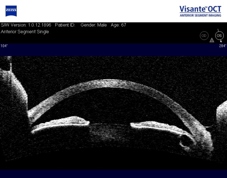 Fig. 6 - Tumor subiridiano