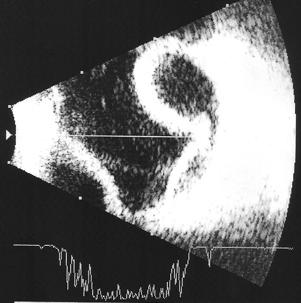 Fig. 4-Descolamento coroideu